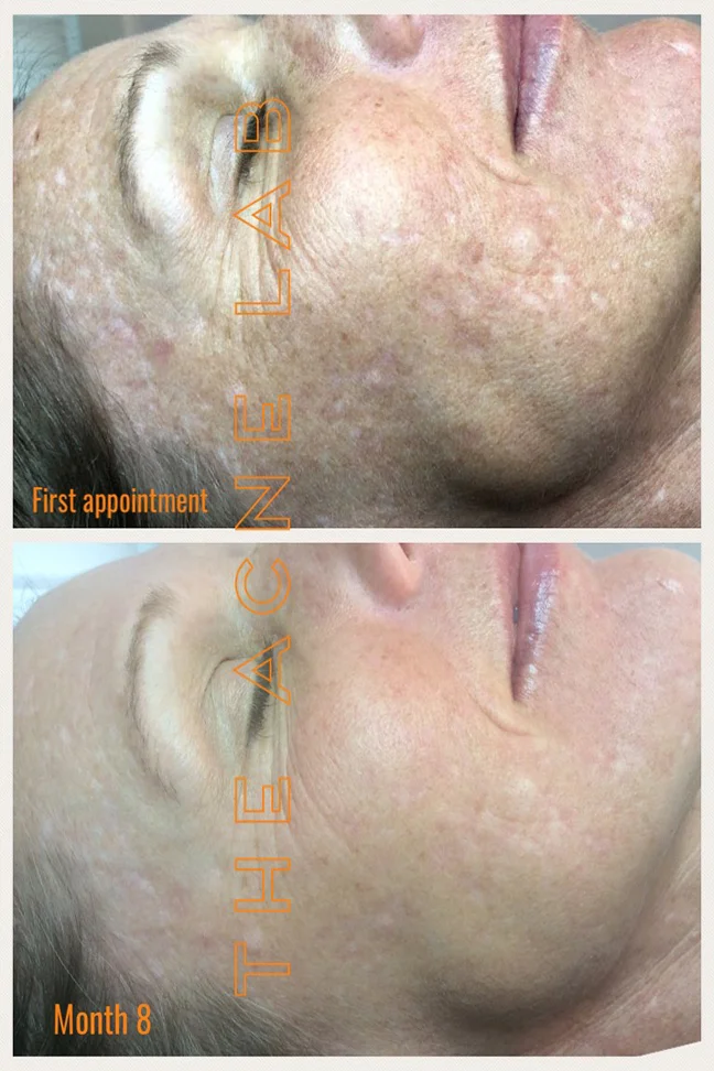 Acne Scars Hyperpigmentation The Acne Lab acne-scars-hyperpigmentation-the-acne-lab