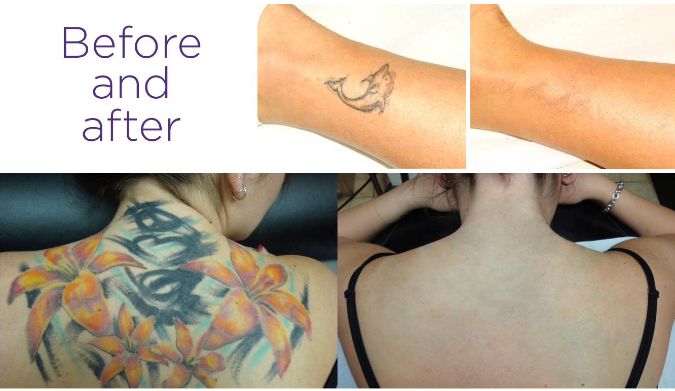 About | Skinful Tattoo Removal | Skinful Laser Tattoo Removal