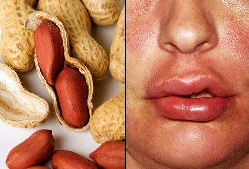 Reaction to peanuts