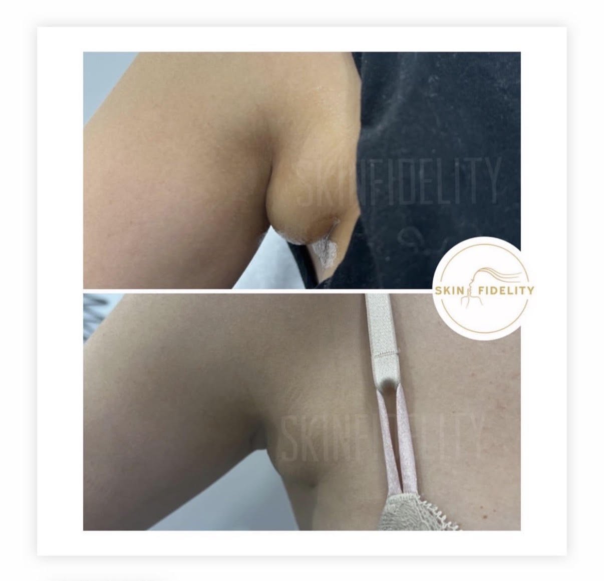 Bra line fat before and after fat dissolving