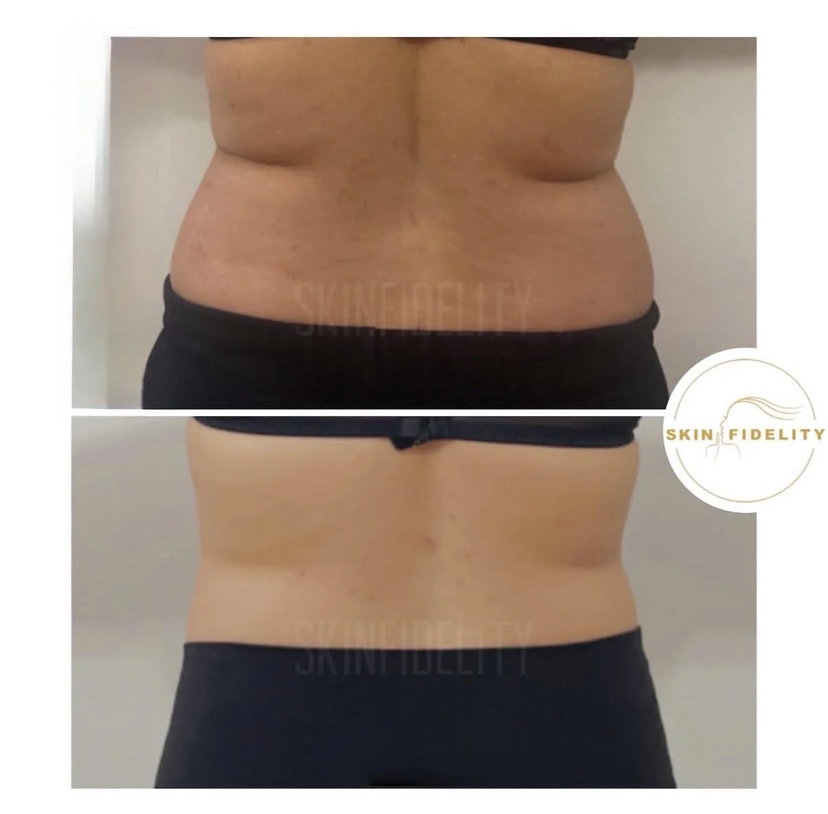 Love handles before and after fat dissolving