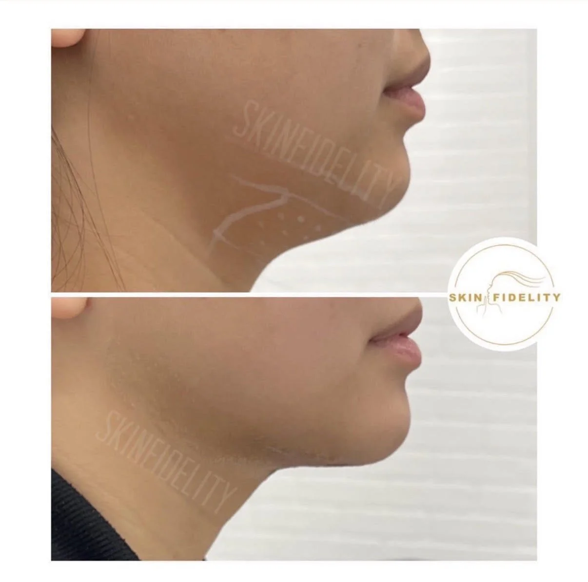 Under the chin before and after Belkyra