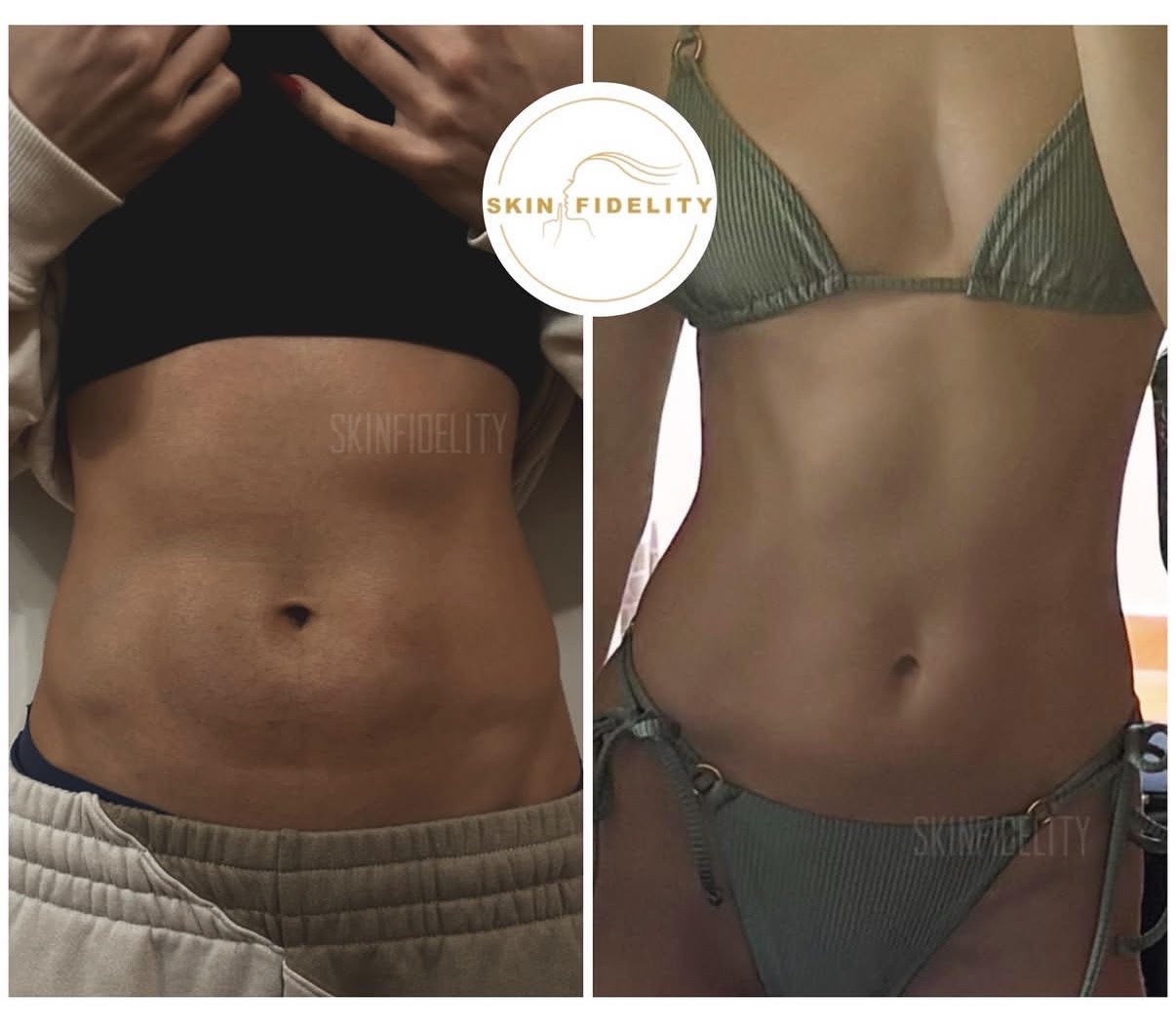 Stomach before and after fat dissolving