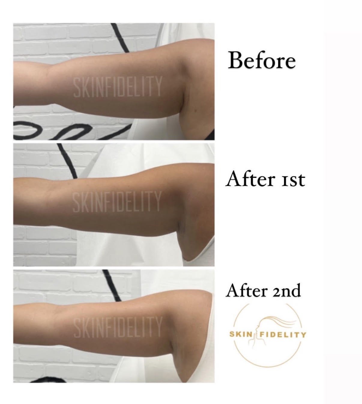 Upper arm before, after first and after second fat dissolving session