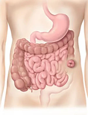 decending colostomy.jpg