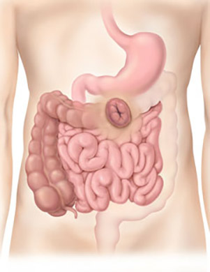 transverse+colostomy.jpg
