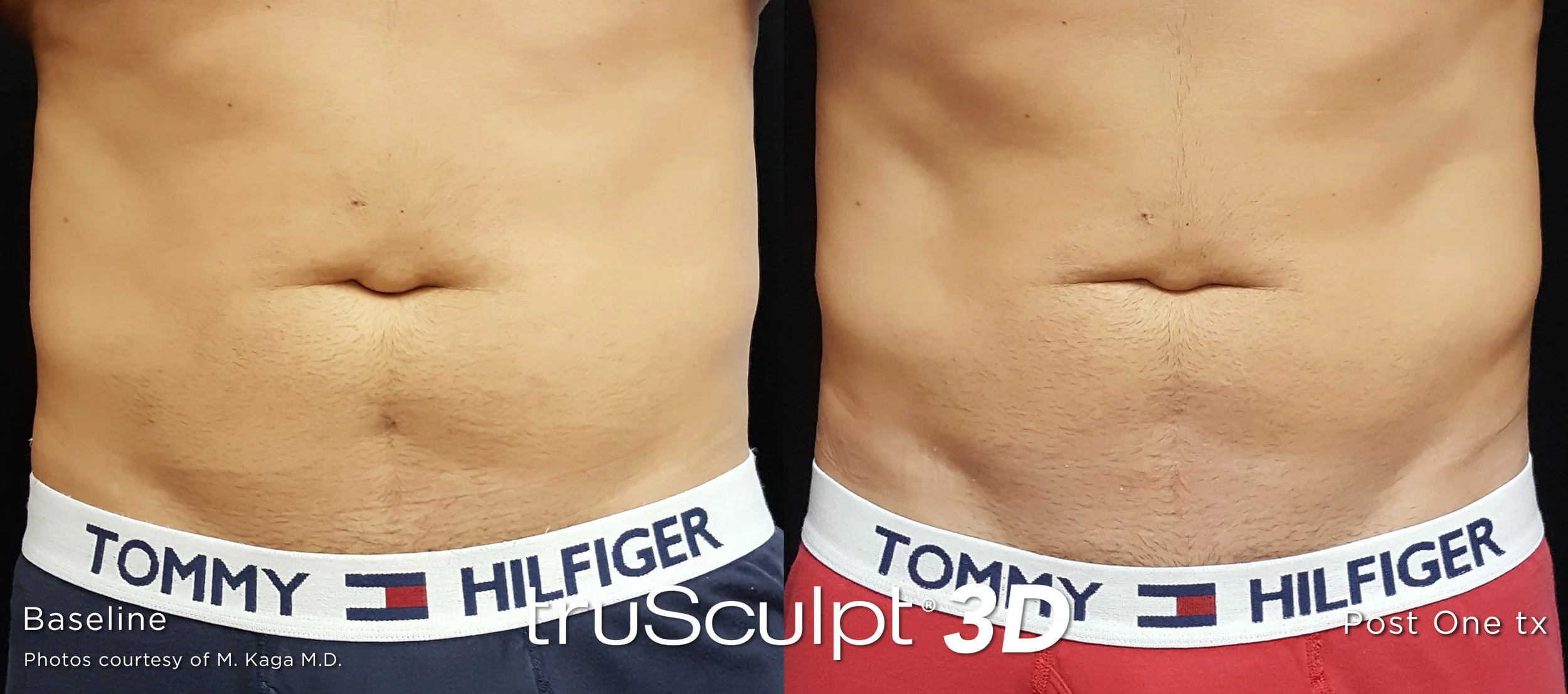 truSculpt-3D-B-A-Image-11.jpg