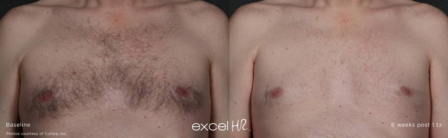 hairremovalmanchest.jpg