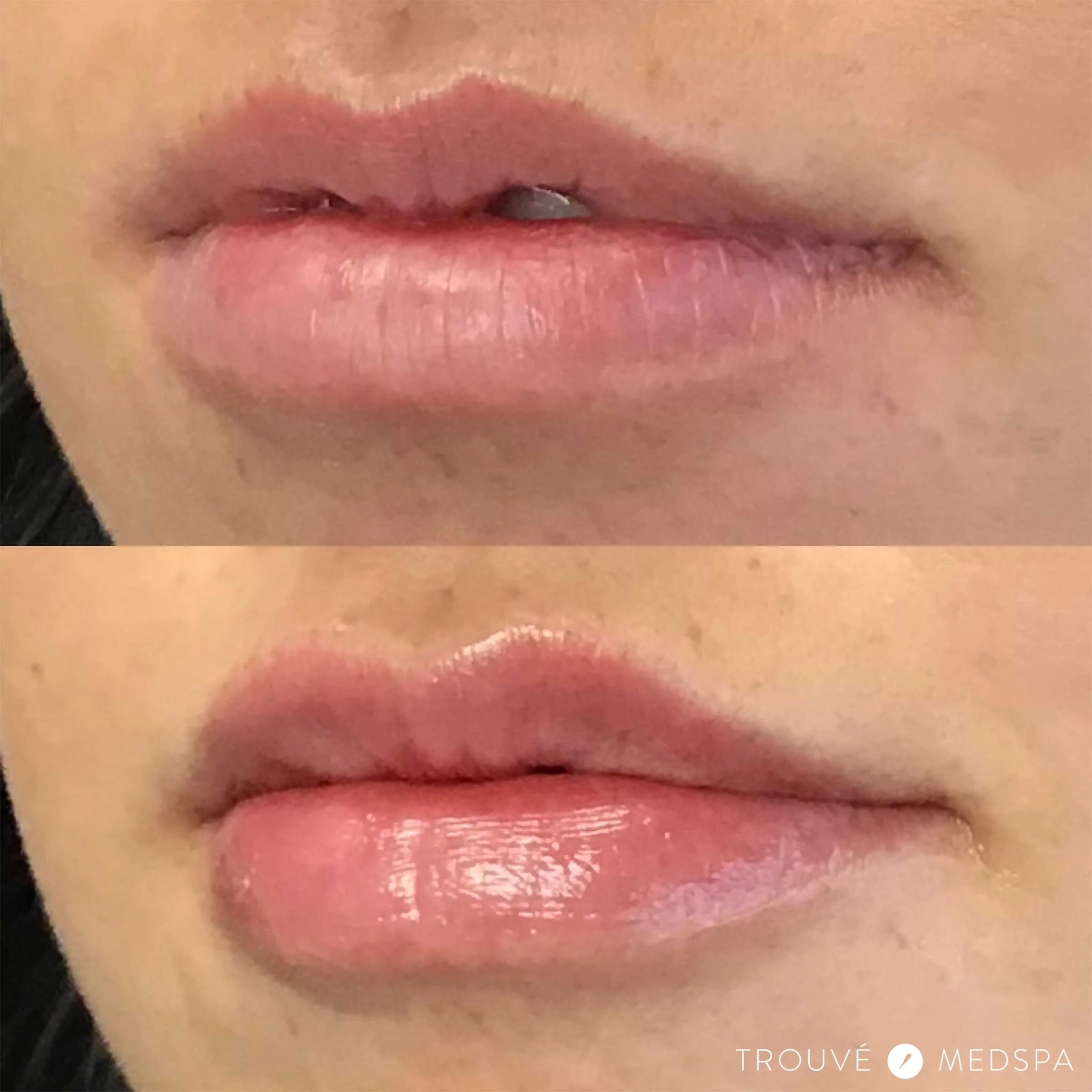The smart Trick of Injectables Burbank - Juvederm & Botox Sherman Oaks - Los ... That Nobody is Talking About thumbnail