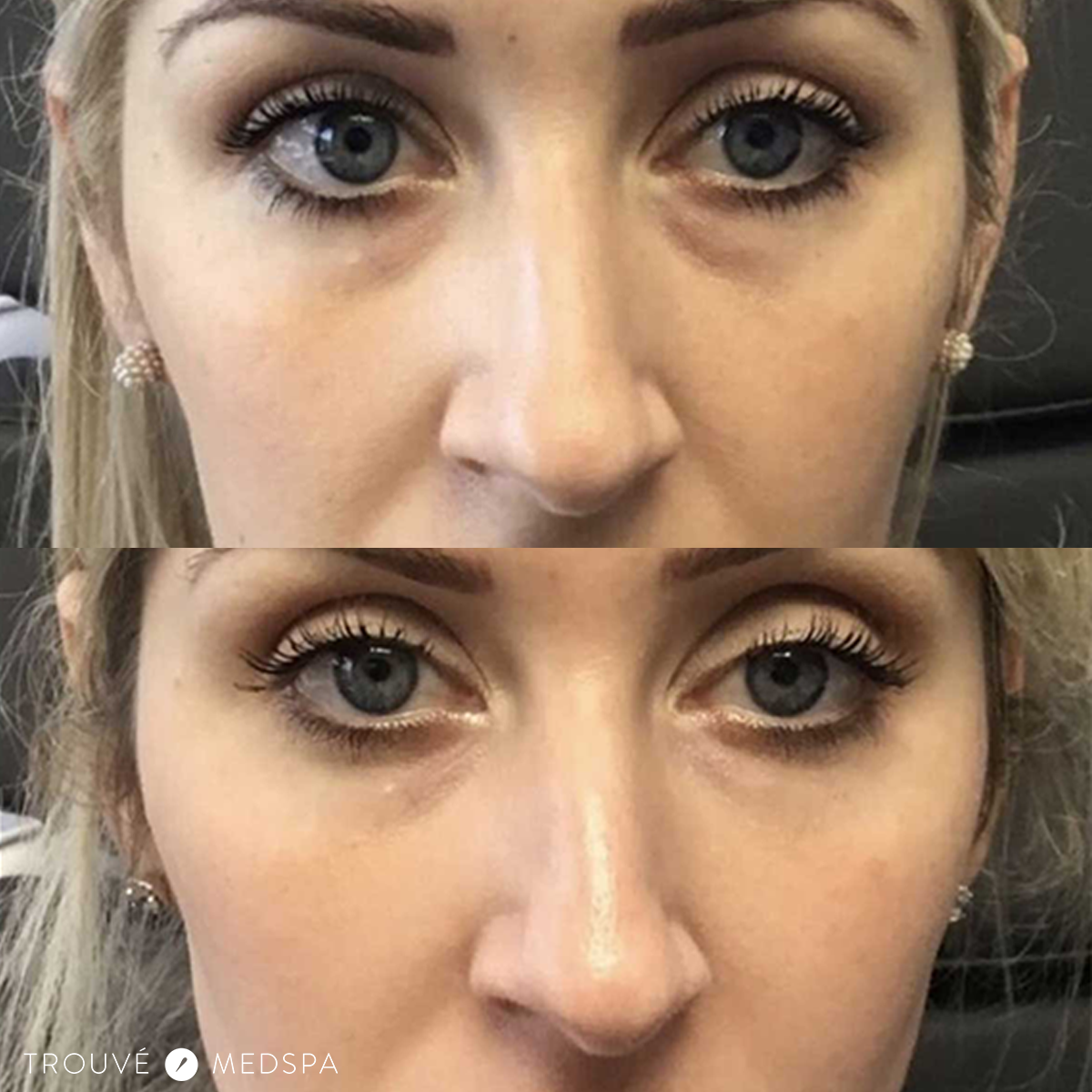 dark under eyes filler