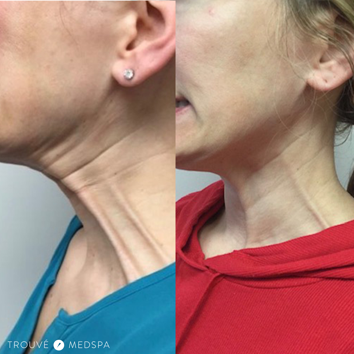 Trouvé Medspa - Neck Bands Botox Cleveland
