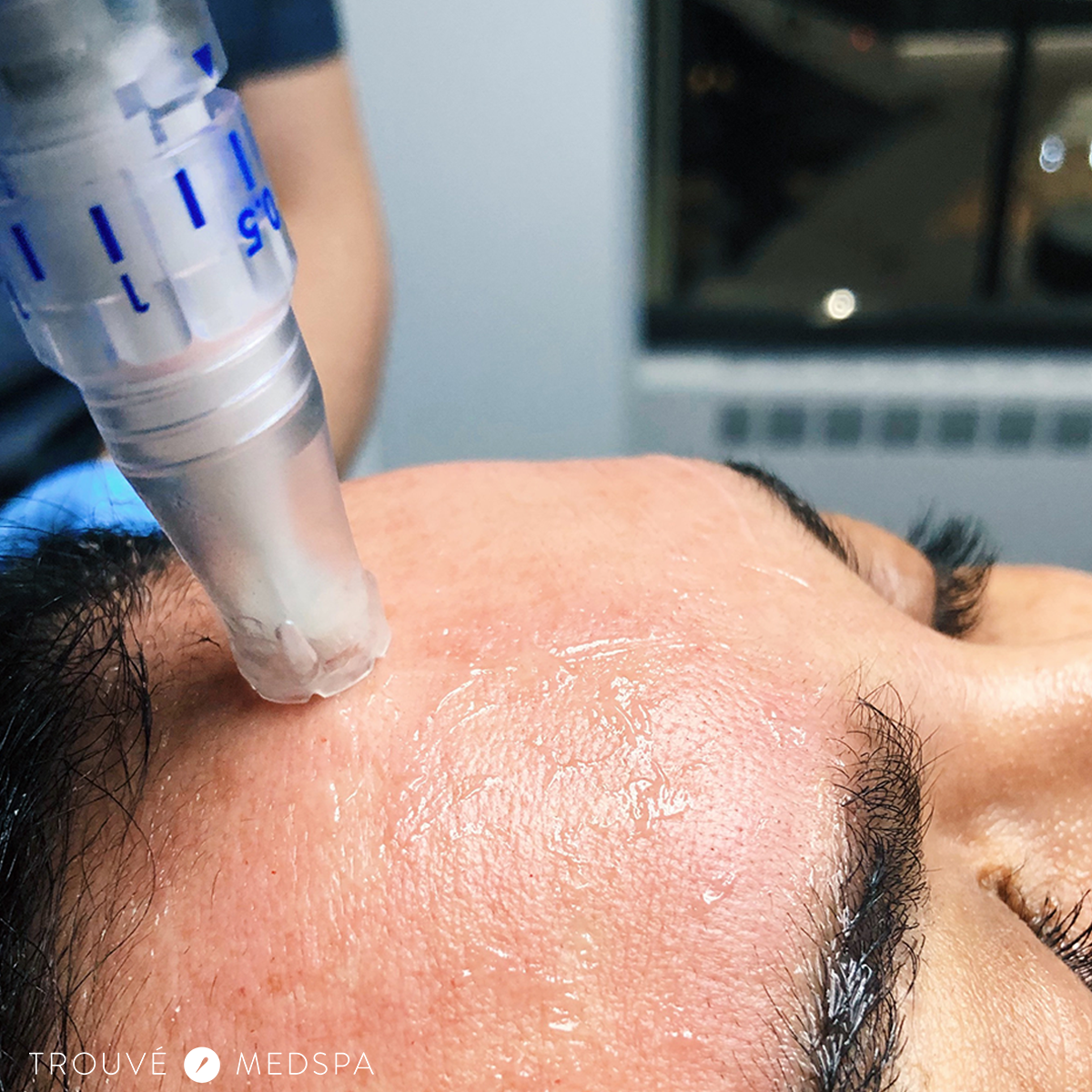 Microneedling Atlanta