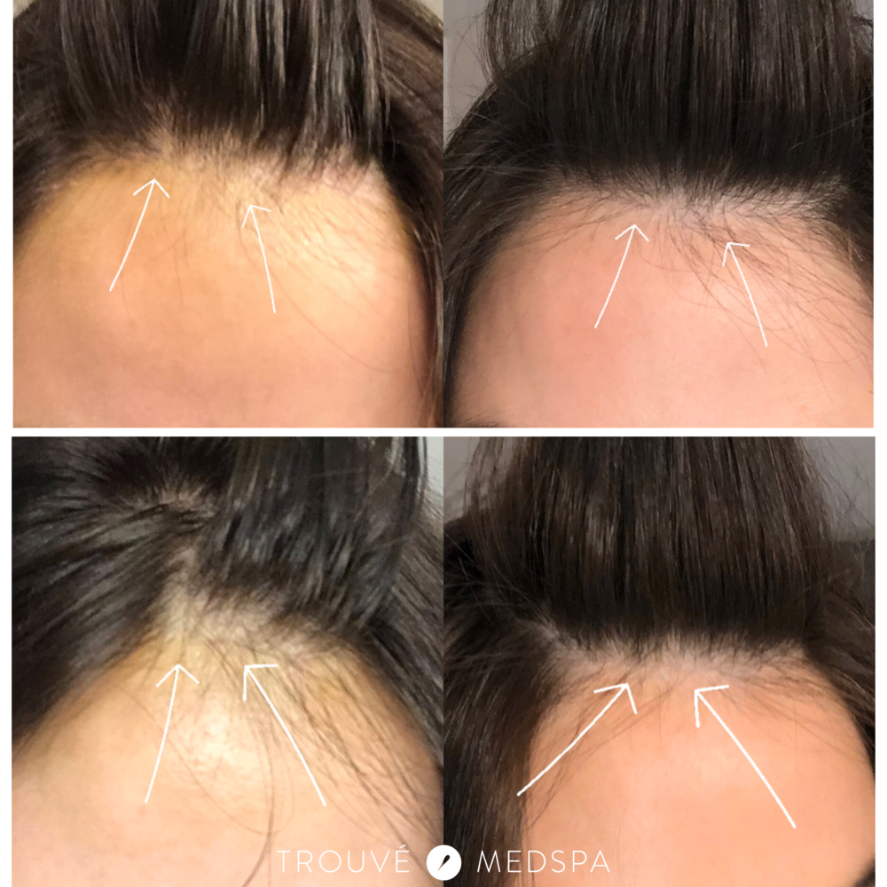 Trouvé Medspa - Hair Loss Treatment Cleveland