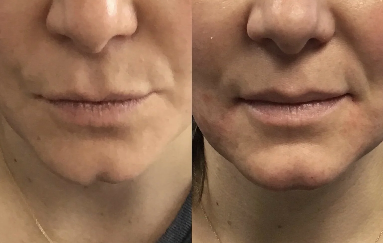 Cleft Chin Removal Before And After