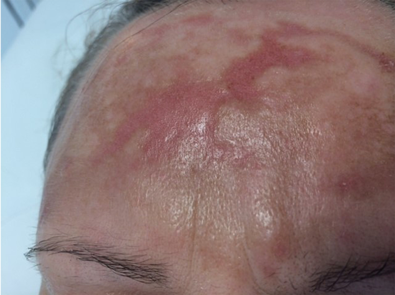 Burn scar on forehead - Before