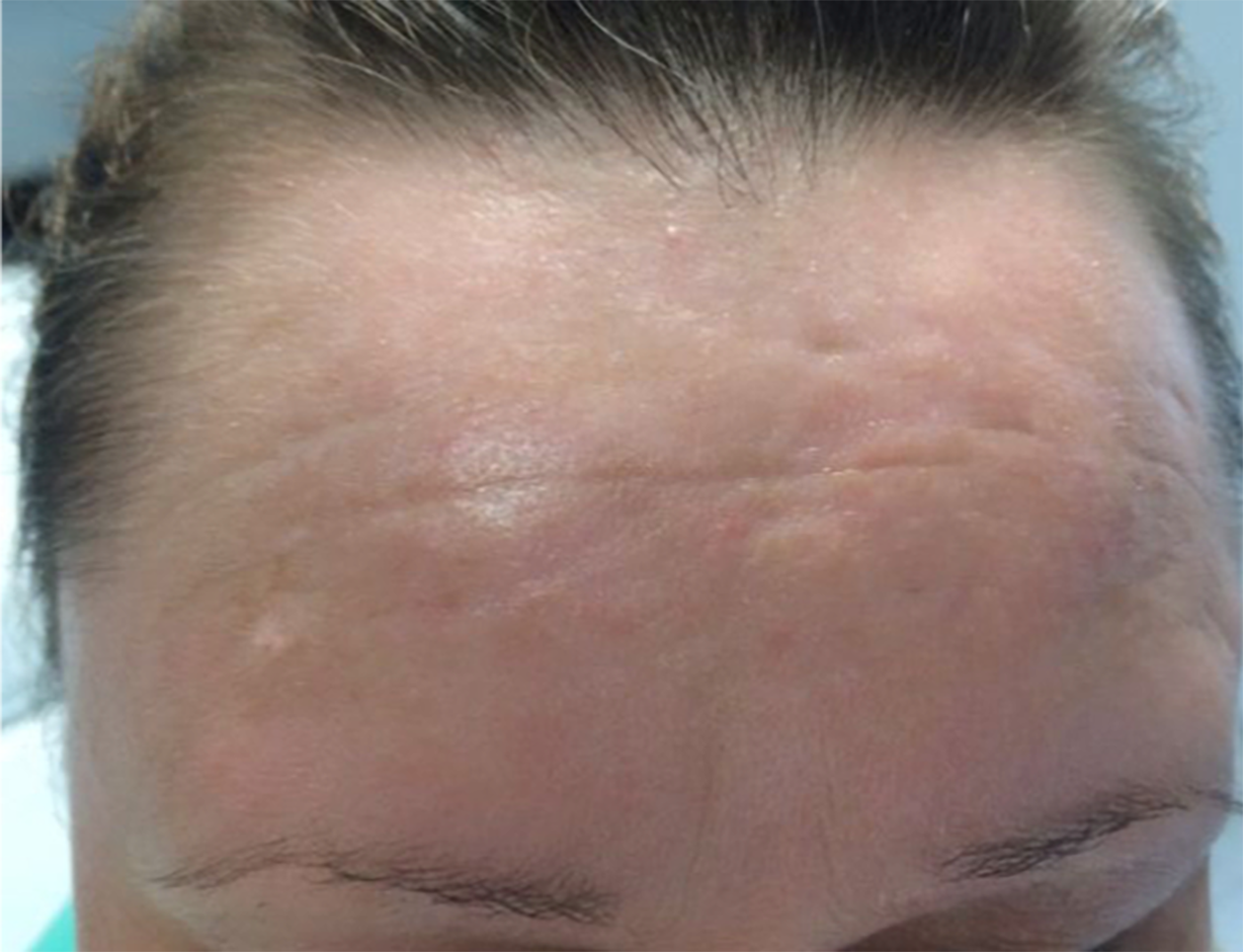Three months after single treatment