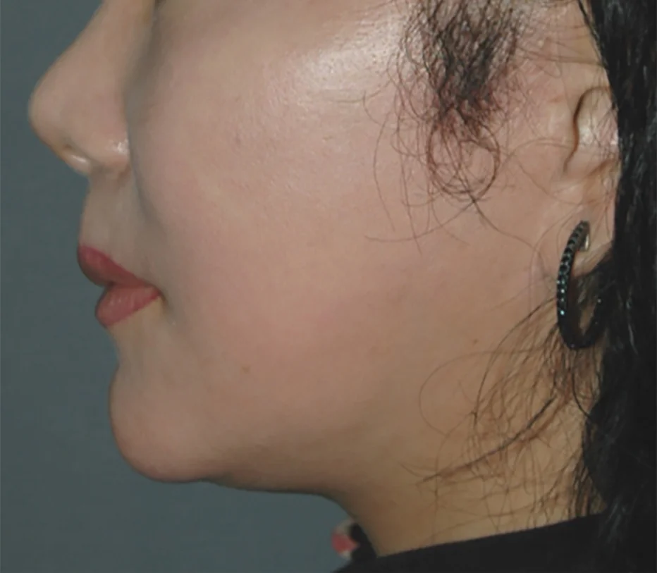 One month after single treatment of the scalp and face