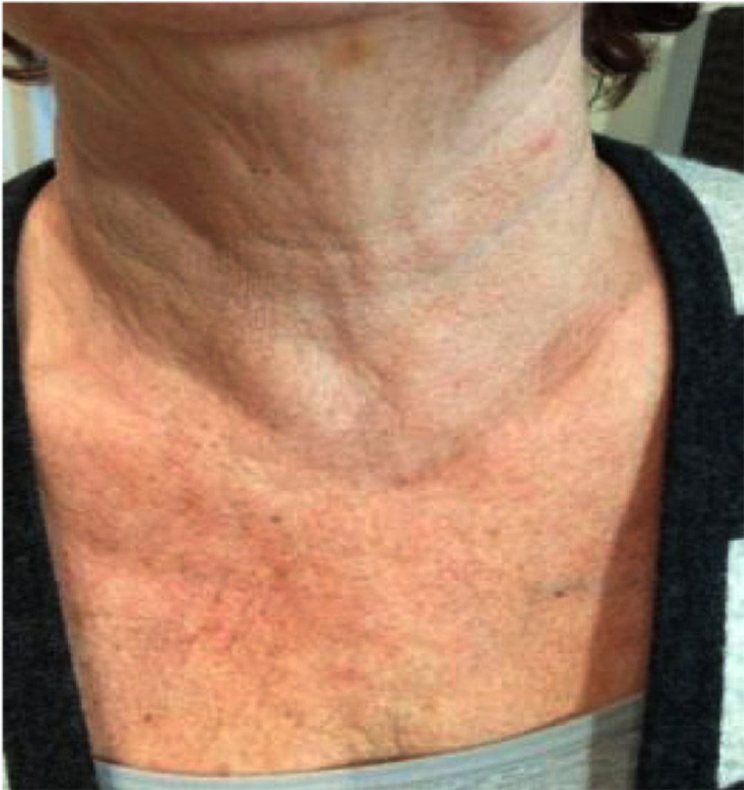 One month after single treatment of the décolletage