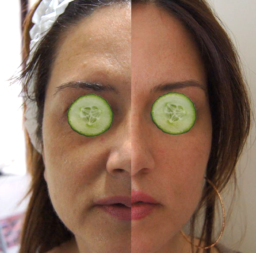 One month after single treatment of the scalp and face
