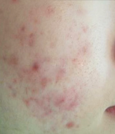 Acne and acne scars - Before
