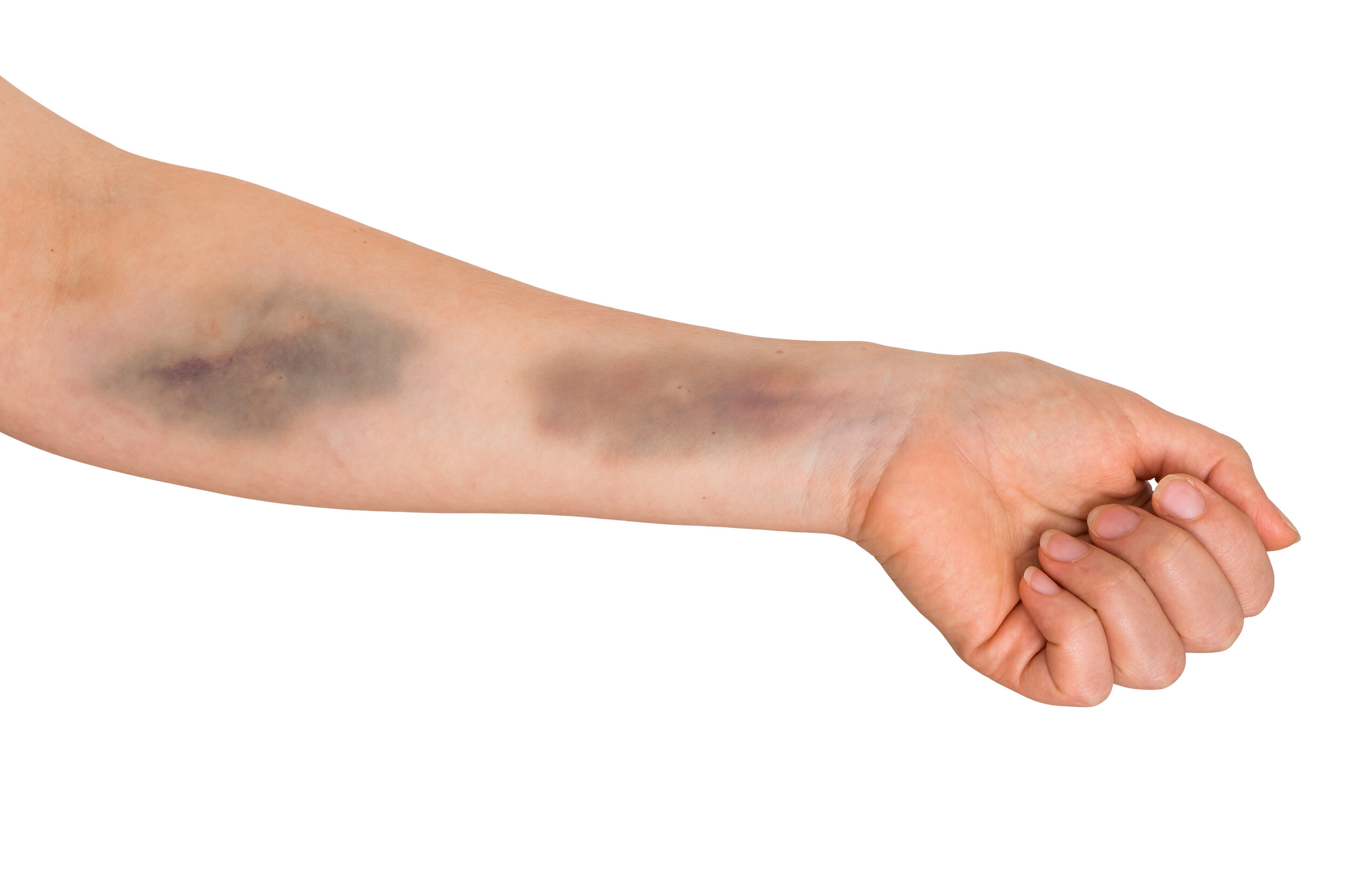 Stop Blowing Veins How Not To Blow Veins When Starting An Iv — The Iv Guy