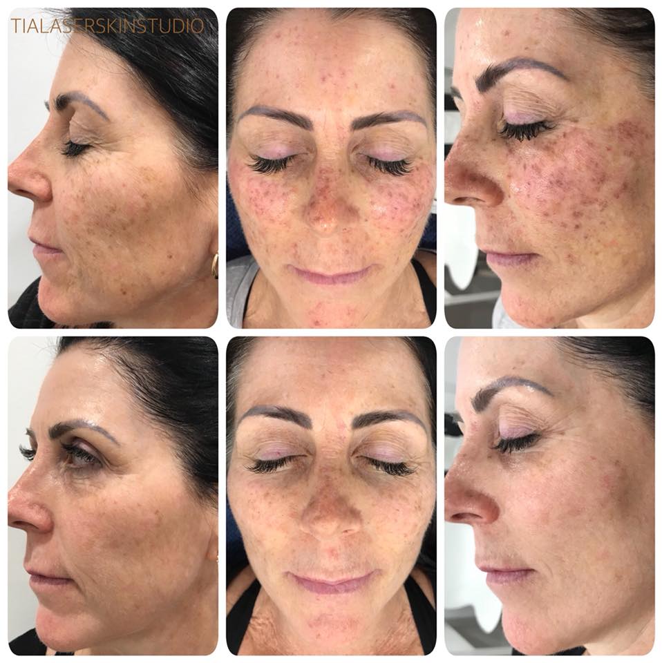 Photo Rejuvenation / Pigment Removal