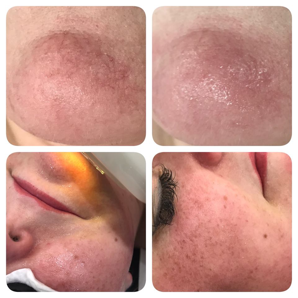 Photo Rejuvenation