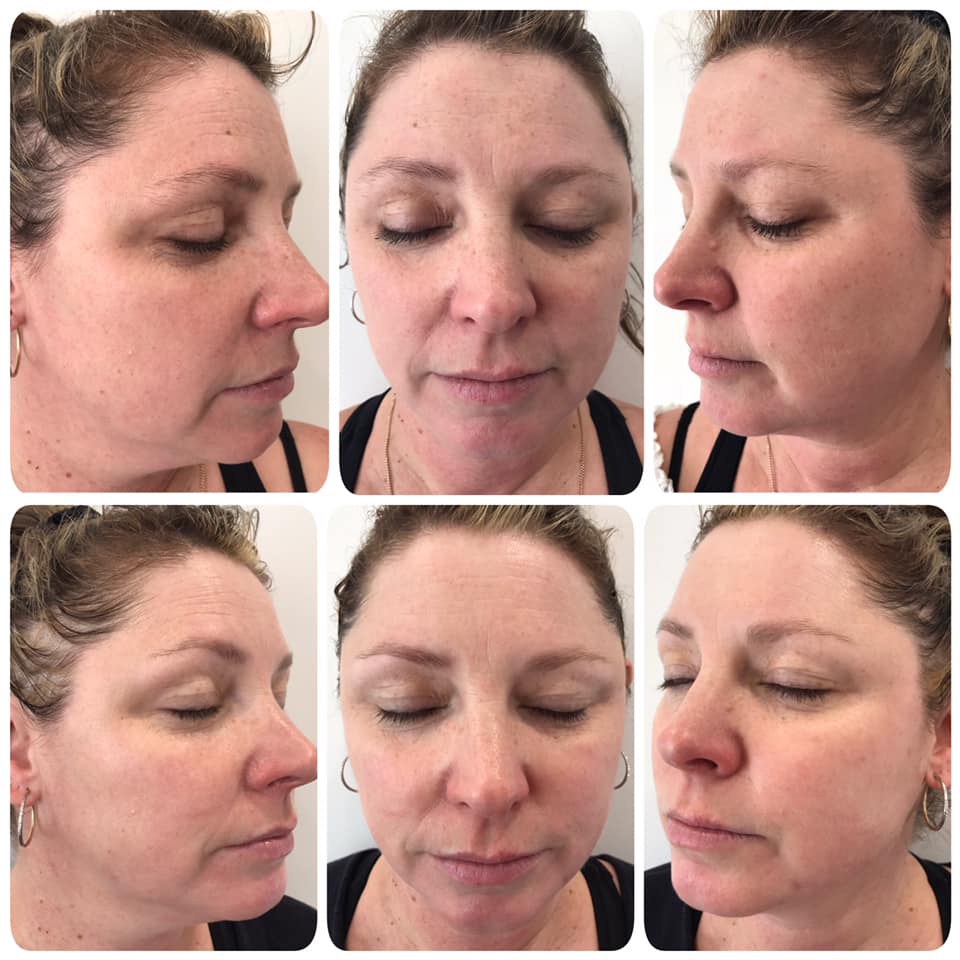 Photo Rejuvenation / Pigment Removal