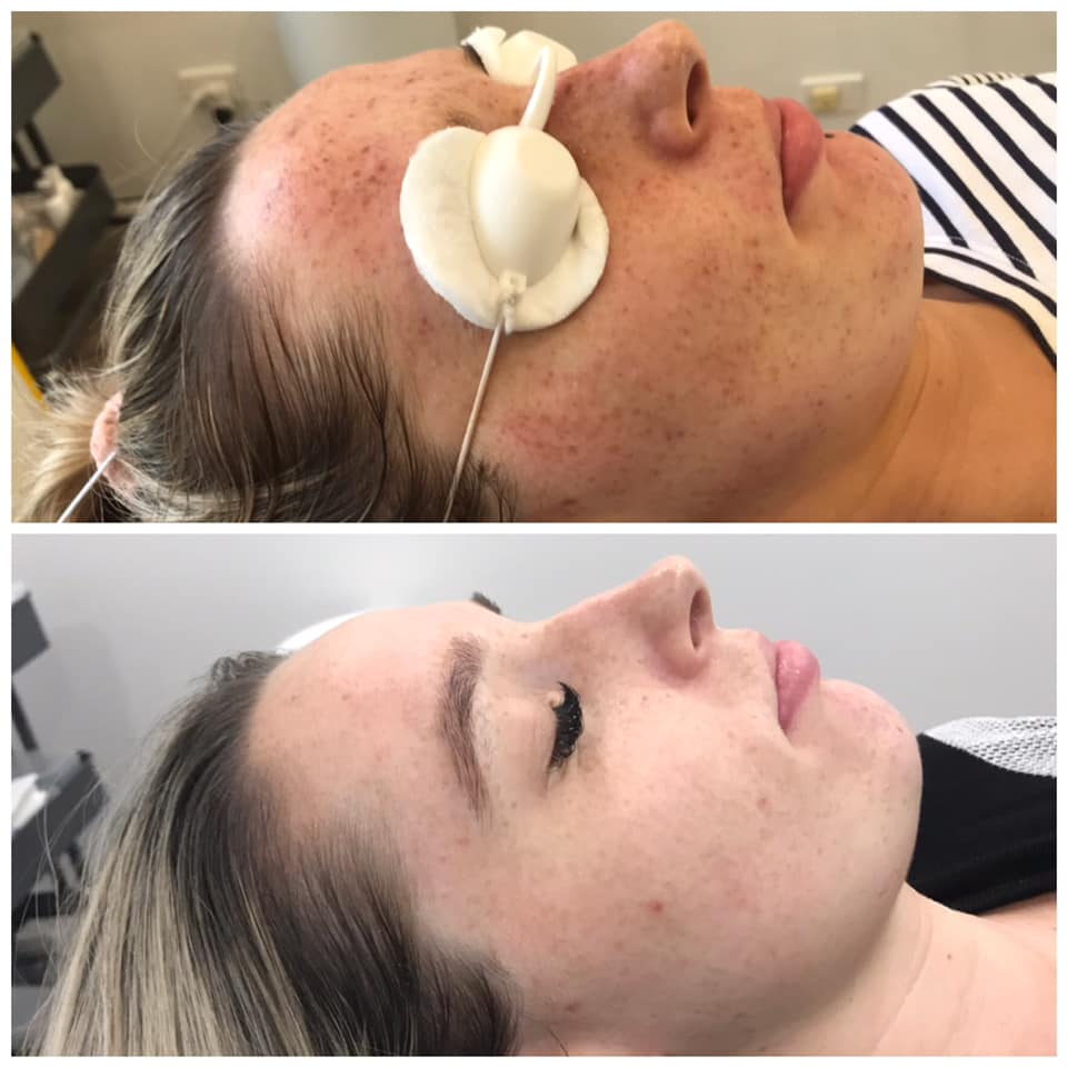 Cosmelan / Pigment Removal