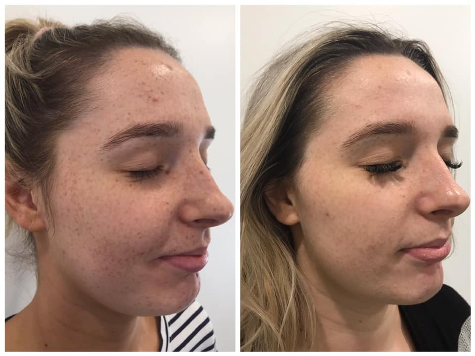 Cosmelan / Pigment Removal