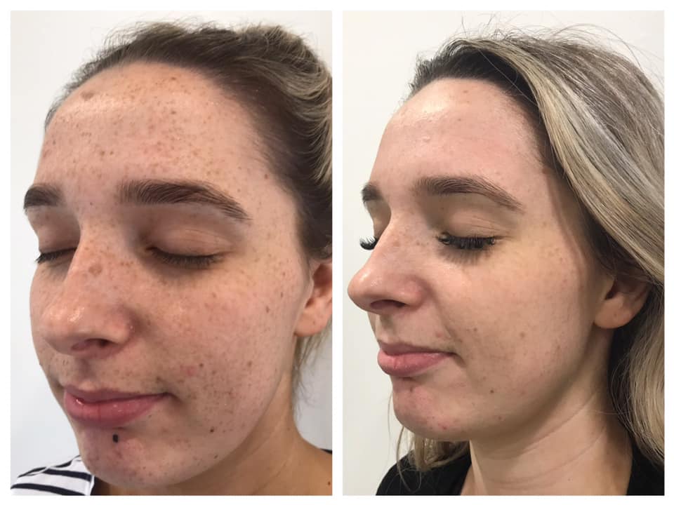 Cosmelan / Pigment Removal
