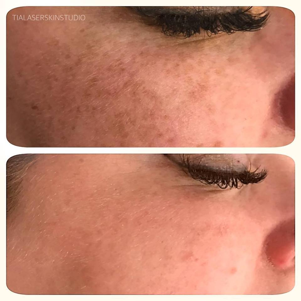 Photo Rejuvenation / Pigment Removal