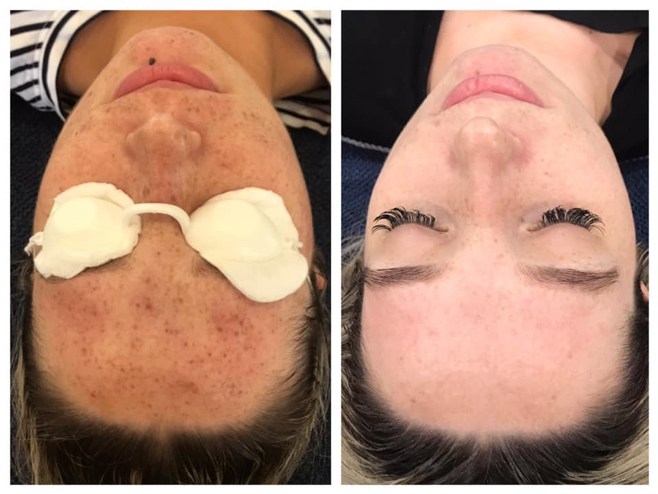 Photo Rejuvenation / Pigment Removal