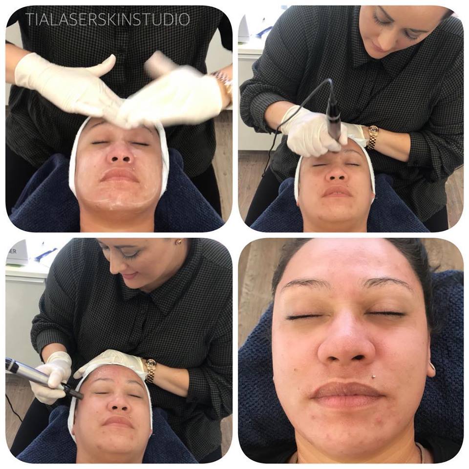 Skin Needling