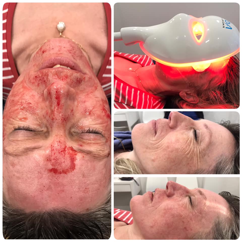 Skin Needling / LED Mask