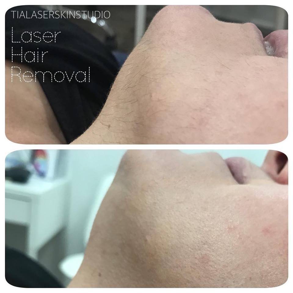 Laser Hair Removal