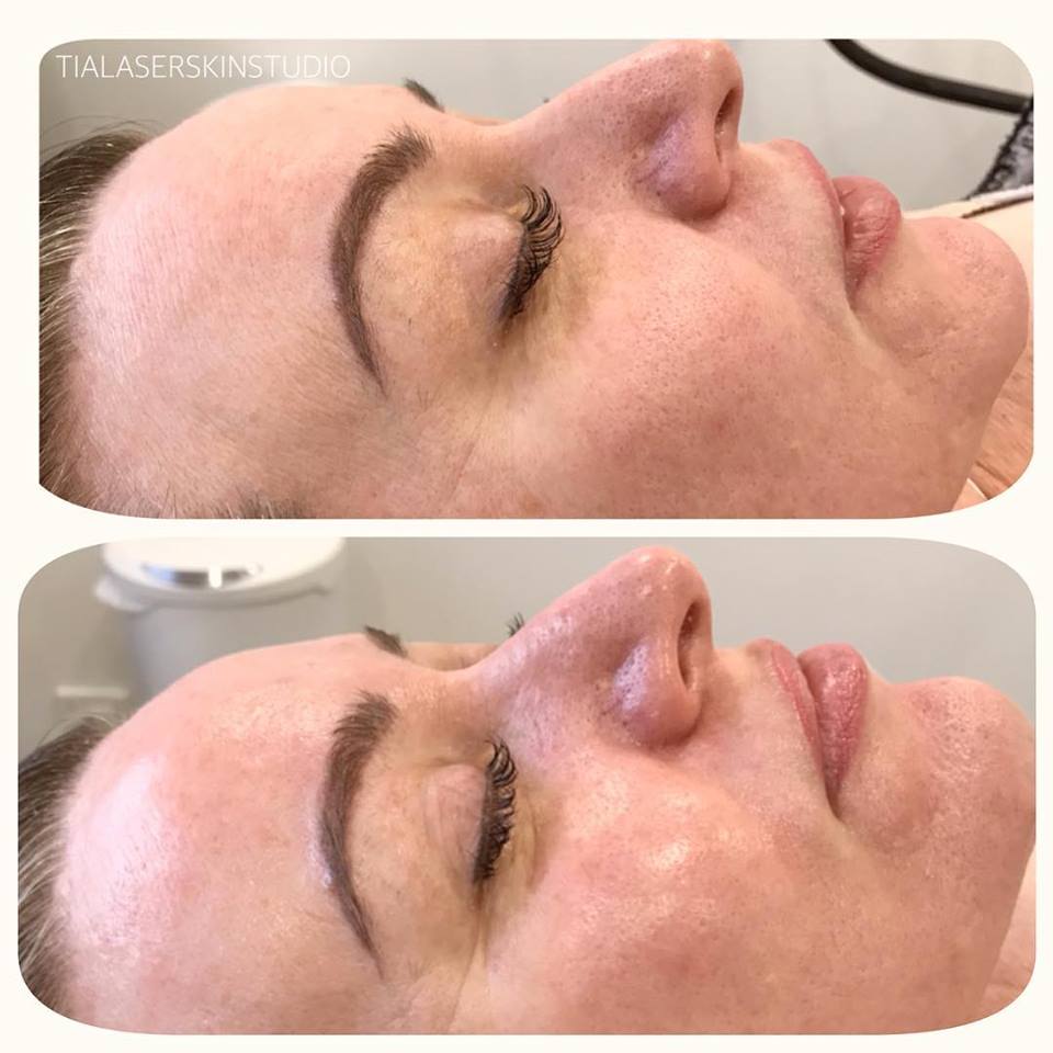 Custom Facial