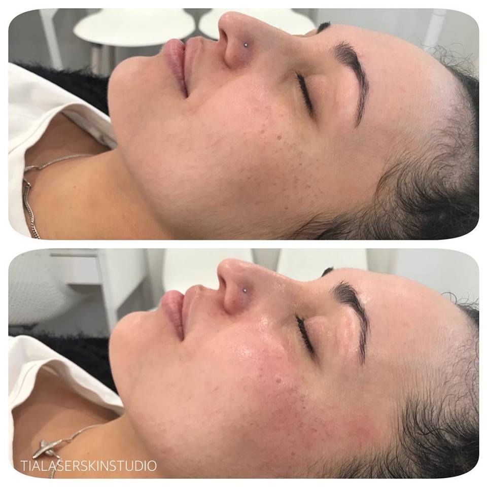 Custom Facial
