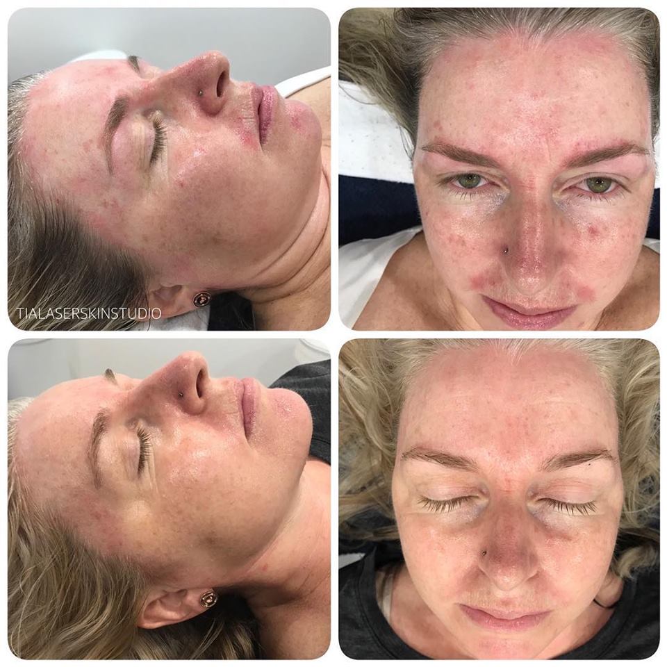 LED Facial