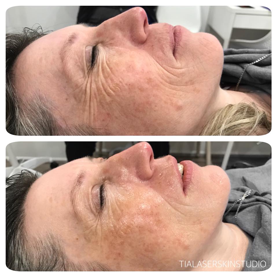 Chemical Peel