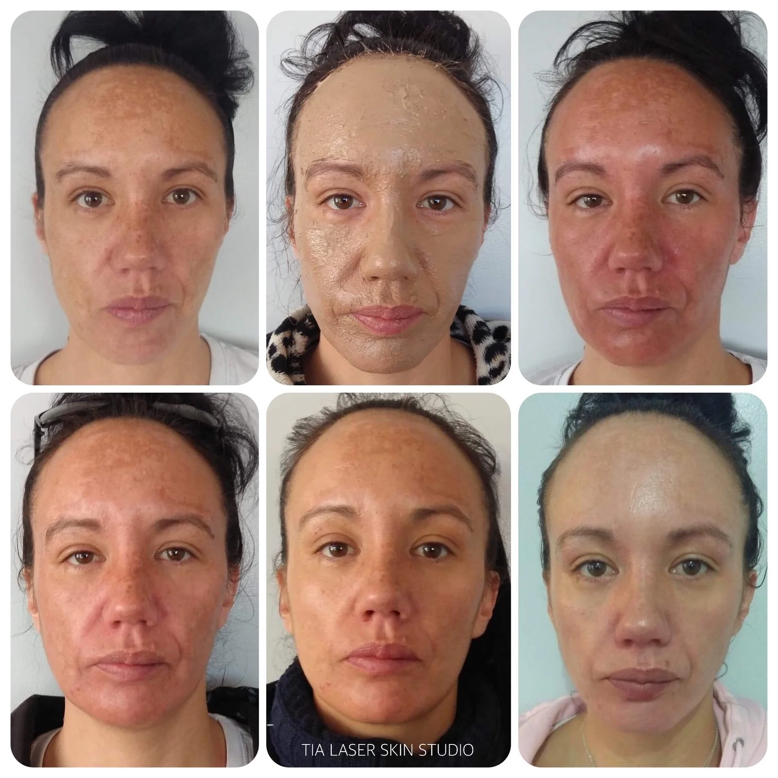 Chivonne Melasma - Process.JPG