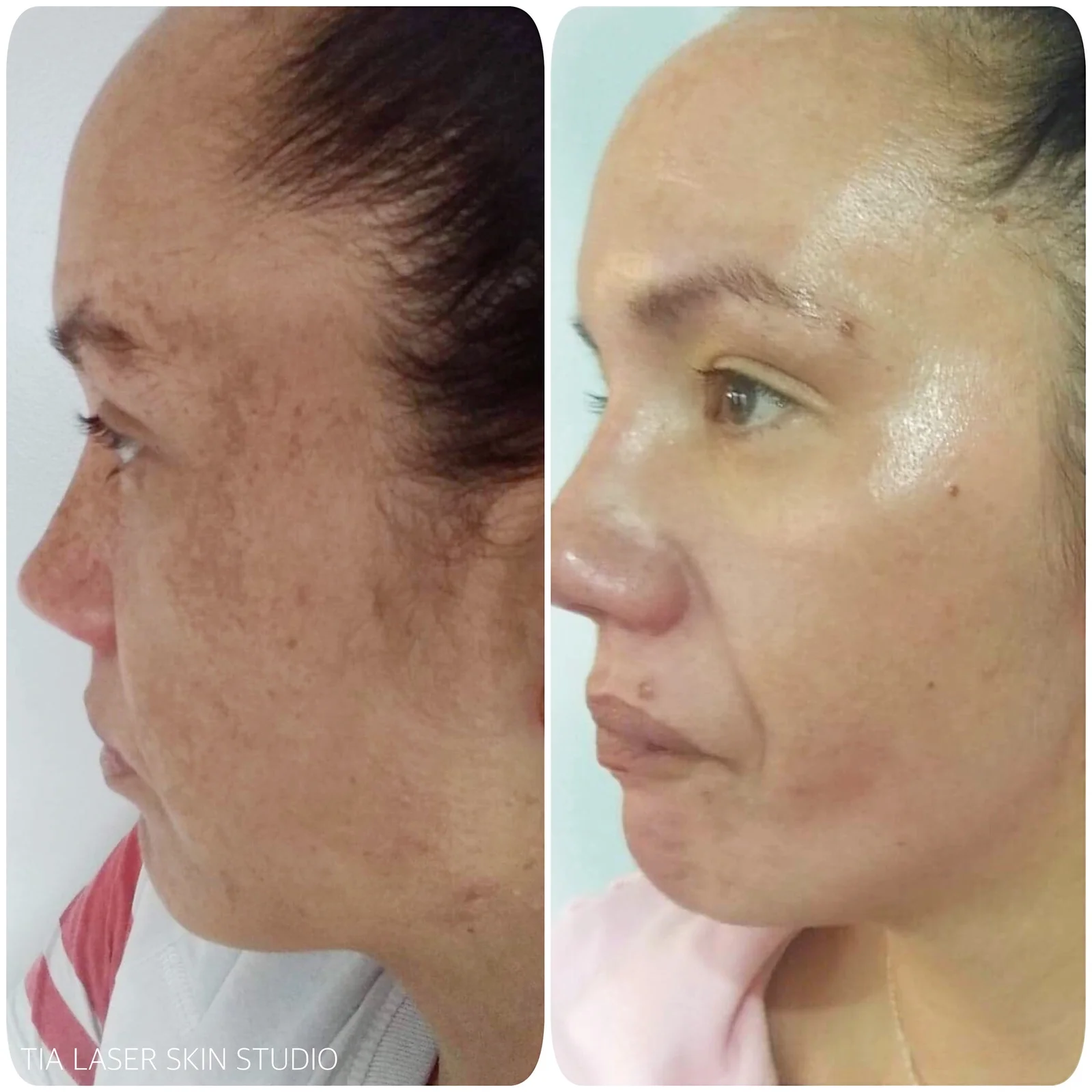 Chivonne - Melasma 1.JPG