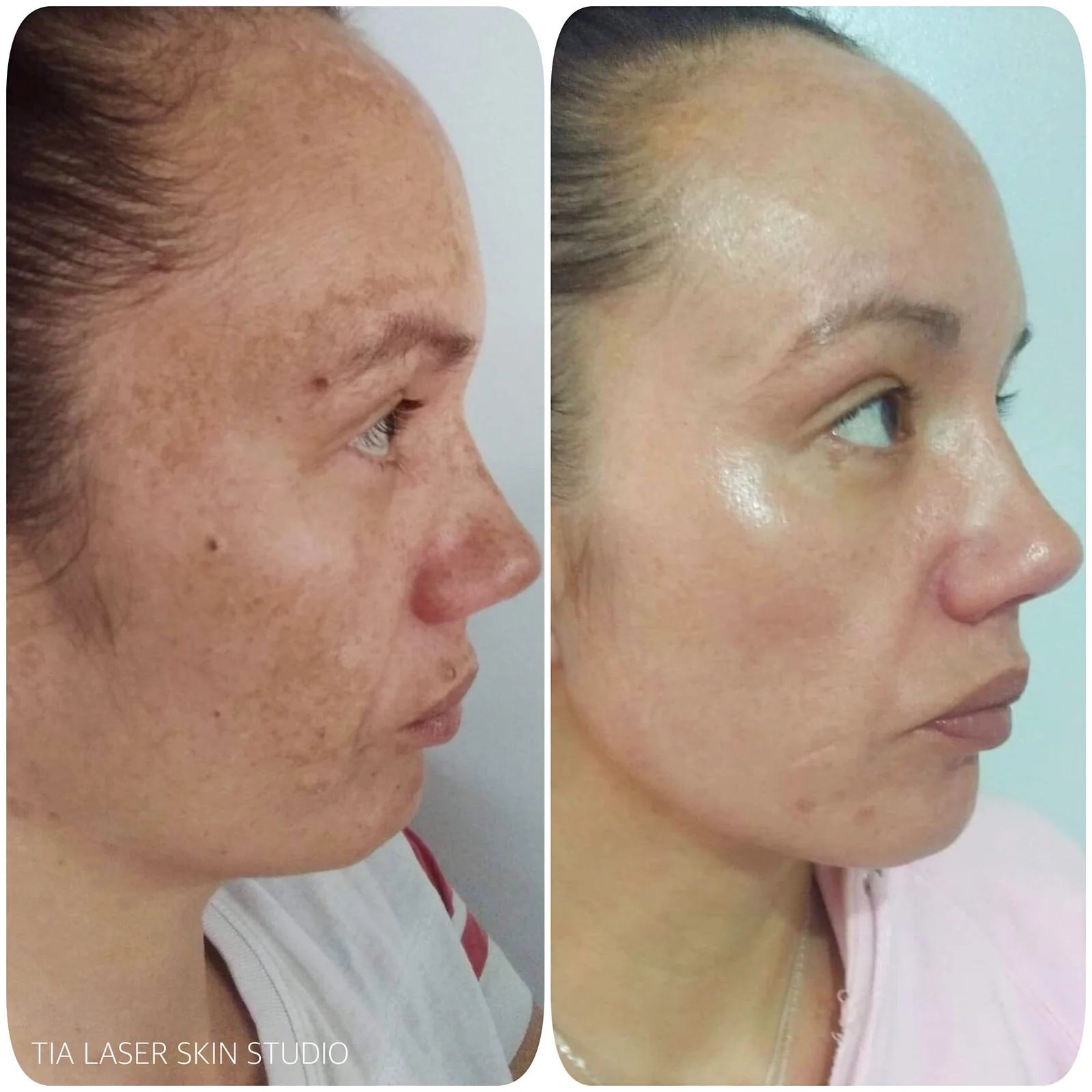Chivonne - Melasma 2.JPG