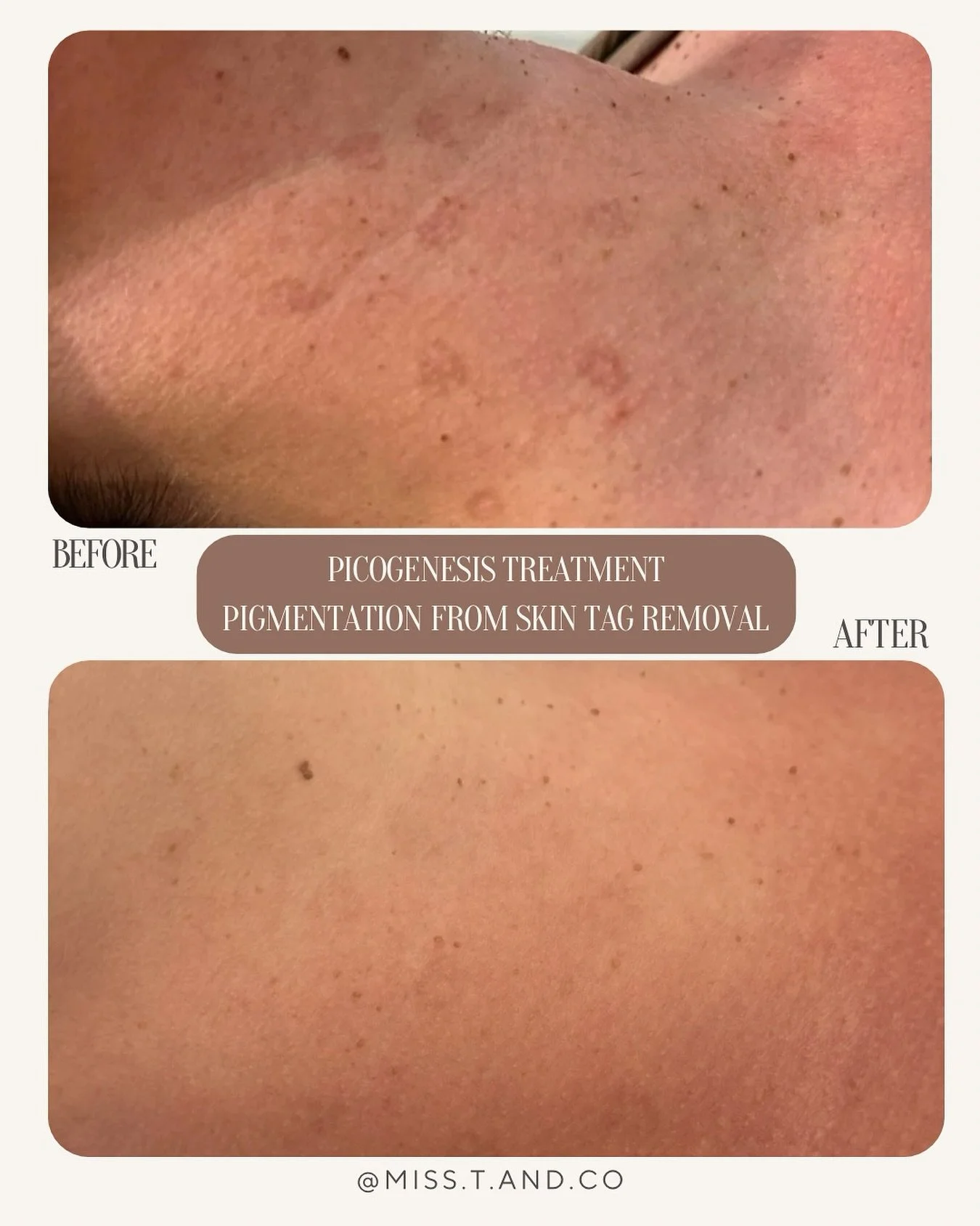 ✨ Real results with Picogenesis ✨

This client had pigmentation left behind from skin tag removal, and just look at the difference after Picogenesis treatment!
Clearer, more even-toned skin and the confidence that comes with it 💫

If you&rsquo;re st