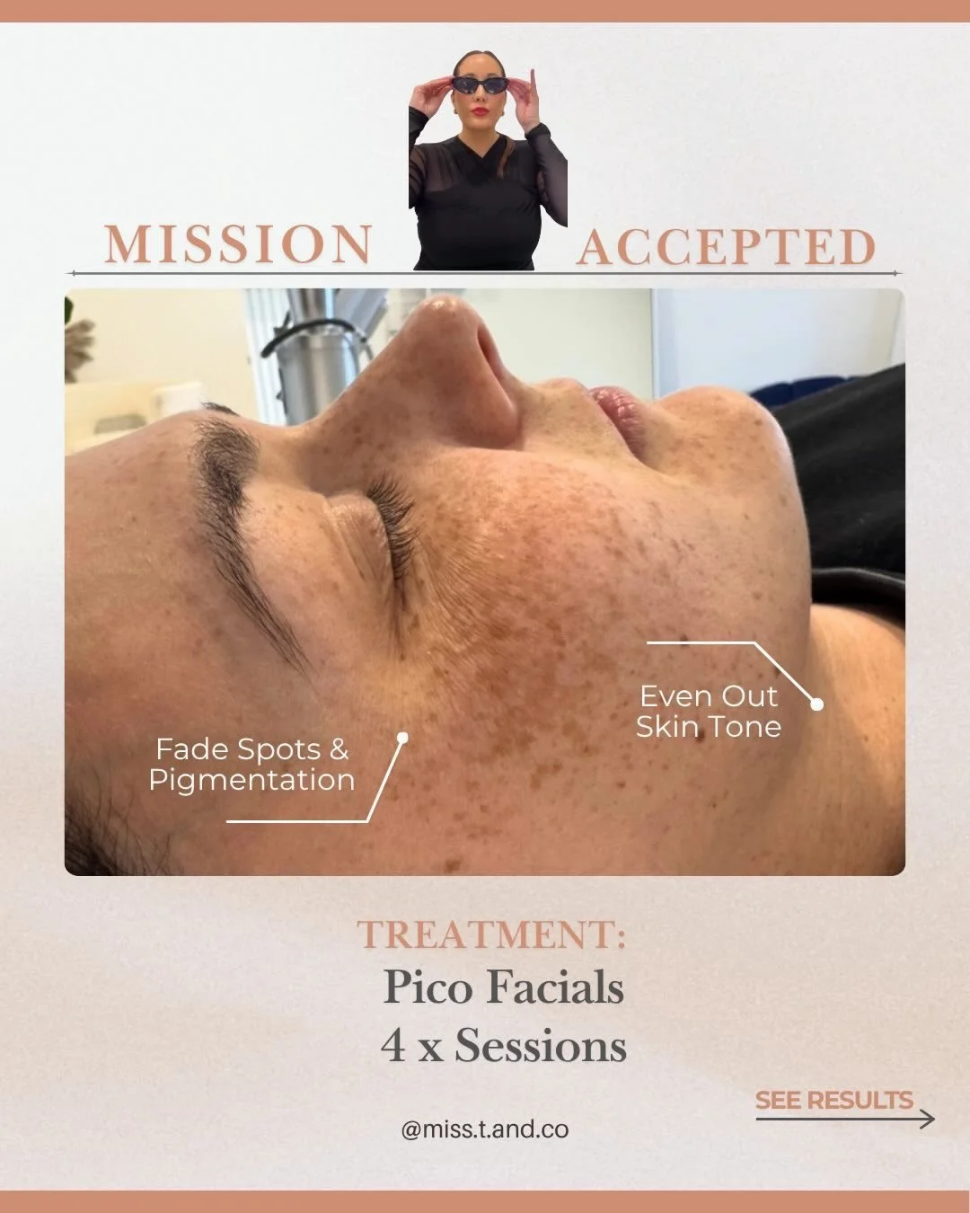 ✨ MISSION ACCEPTED: Softer, Brighter, More Even-Toned Skin ✨

These freckles have always been part of her skin, but over time she noticed they were becoming darker and more prominent.

We had spoken about treatment options for a couple of years, and 