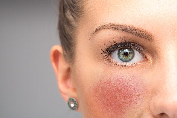 Heat Rash Vs Eczema Whats The Difference — Uptown Dermatology