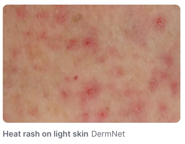 Heat rash, prickly heat, dermatitis and eczema can cause summer