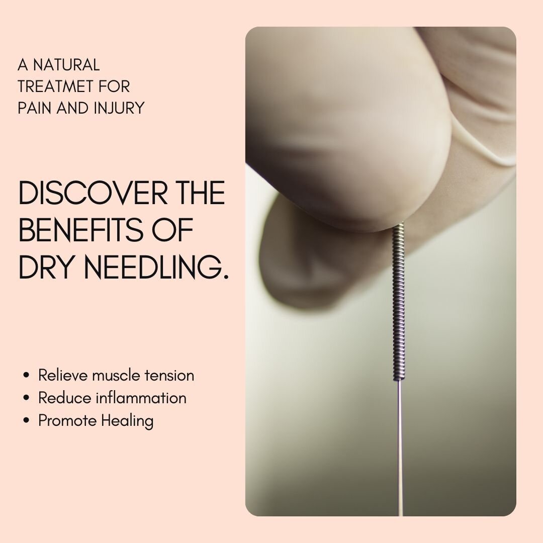 📍 Have you tried Dry Needling? 

Dry Needling is a technique used by healthcare professionals to address musculoskeletal pain and dysfunction. It involves the insertion of thin needles into trigger points in muscles, tendons, or ligaments, without i