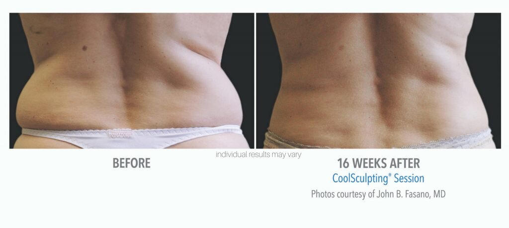 coolsculpting_12-before-and-after-1024x459.jpeg