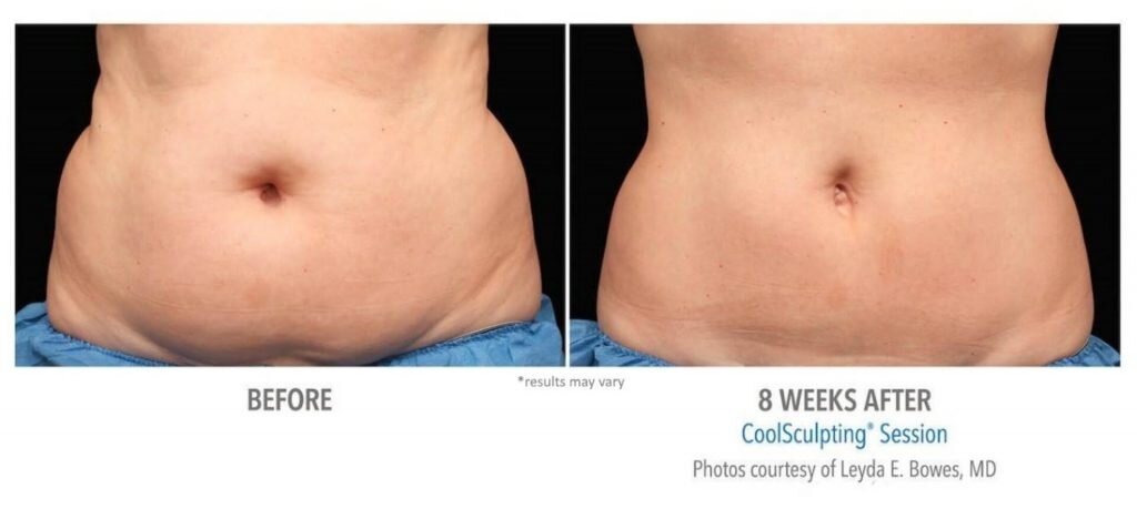 coolsculpting_13-before-and-after-1024x459.jpg